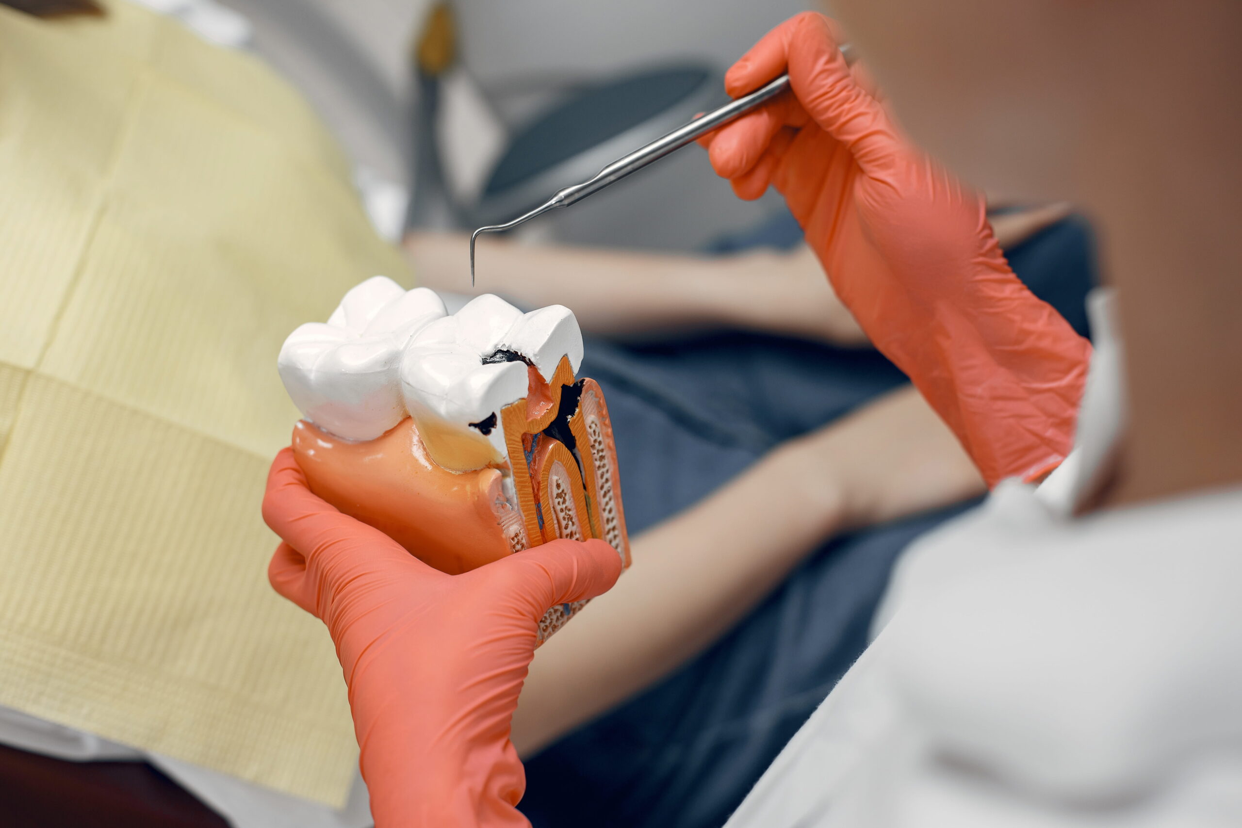 Why Tooth Discolouration May Mean You Need Root Canal Therapy in North York